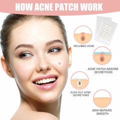 Acne Patch, Face Zit Patch Dot, Stain Cover Sticker, Absorption Acne Patch, Invisible Hydrocolloid Spot Patch, Waterproof   Breathable for Day and Night