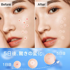 Acne Patch Spot Patch CICA Patch CICA, Hyaluronic Acid, Salicylic Acid Formulation, 180 Pieces for Use (Day + Night)